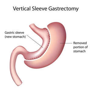 Sleeve Gastrectomy Surgery Illustration 300x300 - Weight Loss Surgery: One Paraplegic Woman's Story of How it Changed Her Life